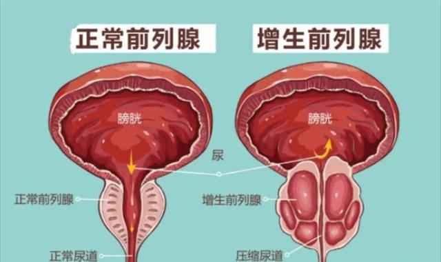 爱健康：他达拉非不仅能治疗ED，还可以抗前列腺增生，中老年男性的福音