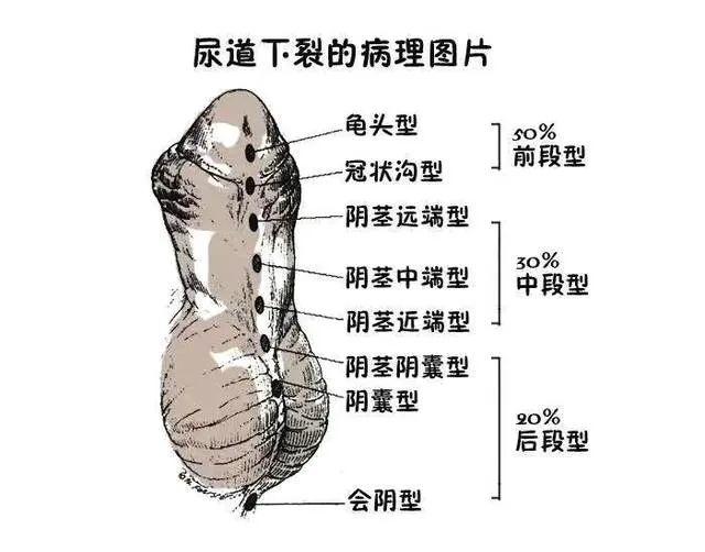 成人情趣：泌尿生殖健康知识您知道多少？《祝您健康》昭通市第一人民医院罗东医生为您解答